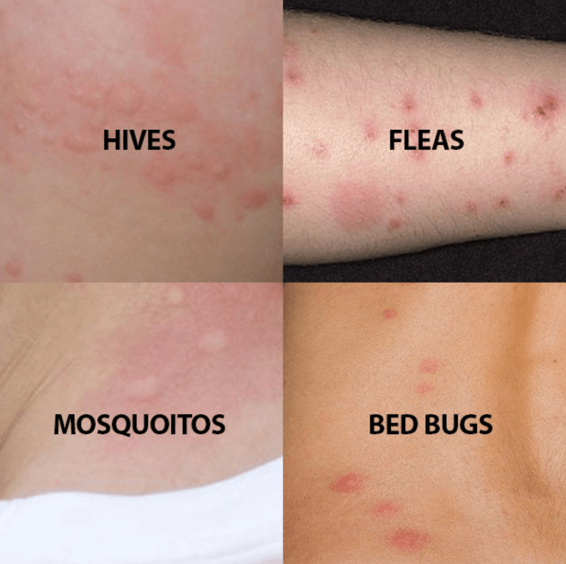 What Are Fleas The Easy Protect Team Discuss   6277399eb7802564ee1c3080 Bed Bugs Bites Vs Flea Bites 